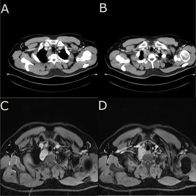 Primary mediastinal Ewing’s sarcoma presenting with sudden and severe chest pain: a case report